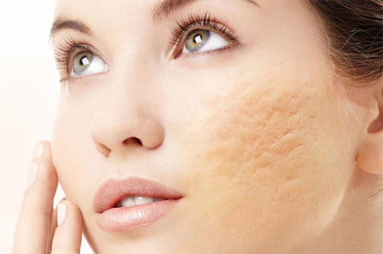 درمانهای گیاهی و خانگی برای جای جوش